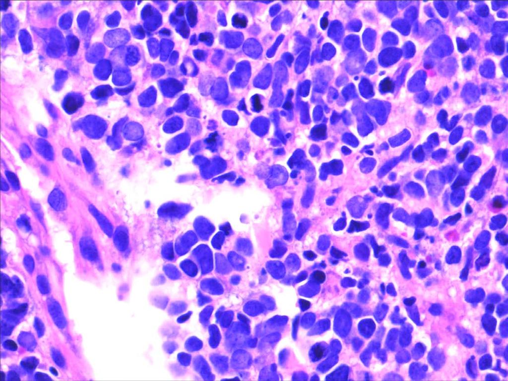 Small Cell Carcinoma or other High-Grade Neuroendocrine Carcinoma In the oropharynx, often related to HPV 5/9;