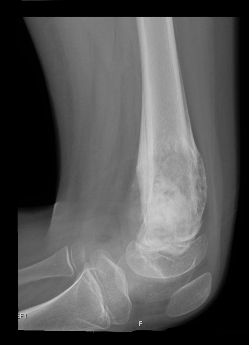 Fig. 10: Conventional osteosarcoma of the distal metaphysis of the right femur. In this lateral view the periosteal reaction, as well as the underlying tumor matrix, becomes much more apparent.