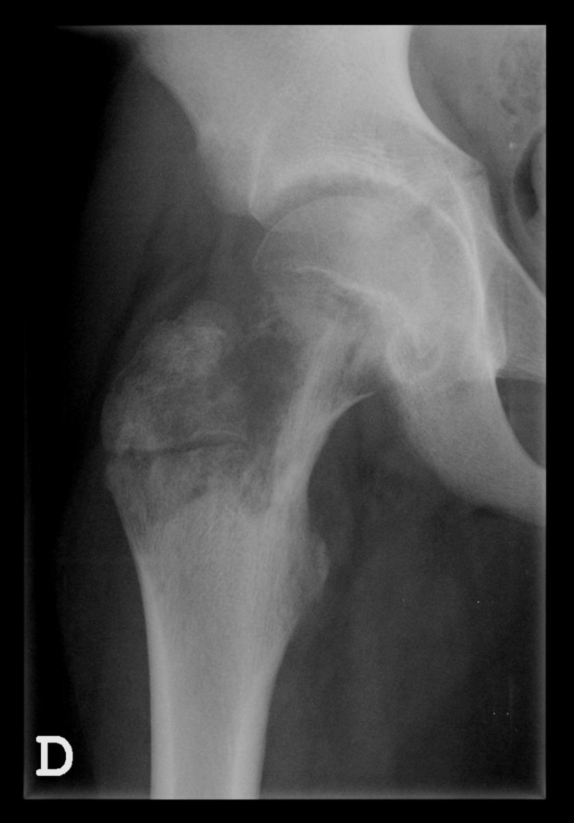 Fig. 16: Primary Bone Lymphoma- Osteolytic, permeative lesion with involvement of the right femoral metaphysis.