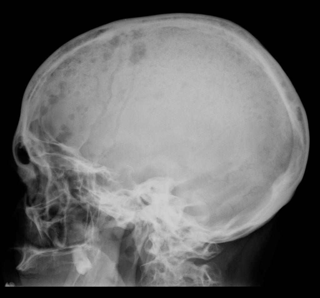 Age: elderly population (frequently between the fifth and seventh decades) Appearance: well circumscribed osteolytic lesions ("punched-out"), "scalloping" of the inner cortical margin, diffuse loss