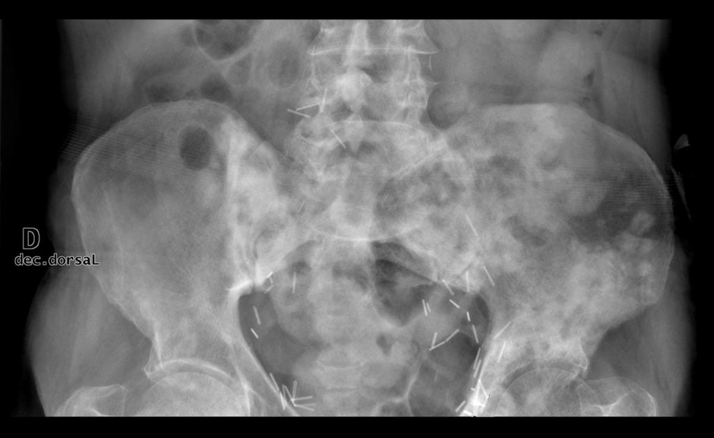 Fig. 21: 57 year-old male patient who had a metastatic bladder carcinoma.
