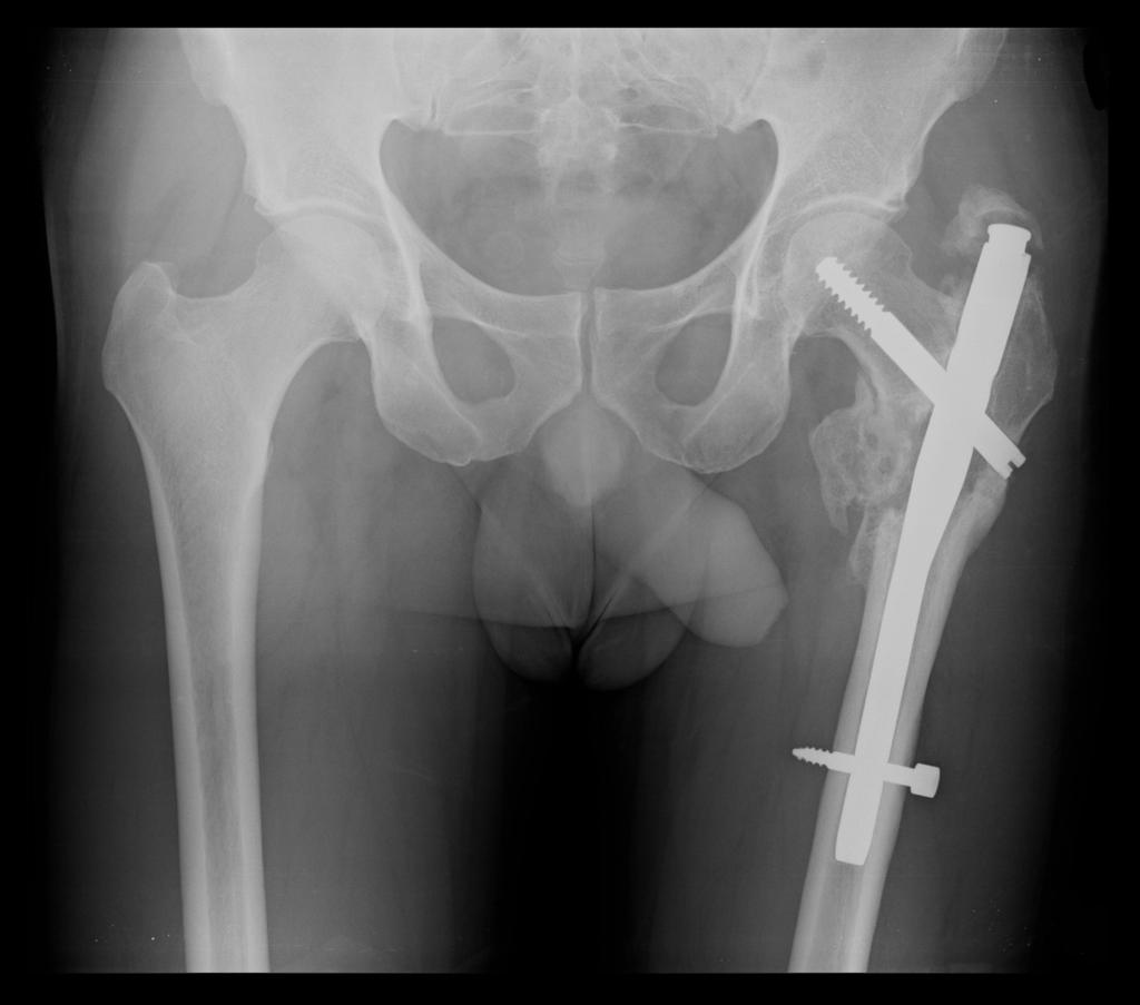 Fig. 24: 43 year-old male with a pathologic fracture of the left femur.