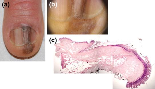 of nail plate in correspondence of the band and pigmentation of the hyponychium and the proximal nail fold (Hutchinson s sign).