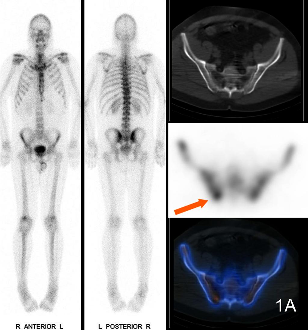 FIGURES Figure 1 53 year old patient, 6 years after surgery. Rising PSA 3.0 ng/ml. Bone scintigraphy including SPECT/CT was read as negative, also in the right iliac bone (arrow) (1A).