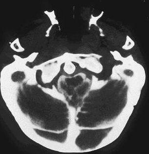cervical spine in a patient who had an atlanto-occipital fusion. Figure 16.