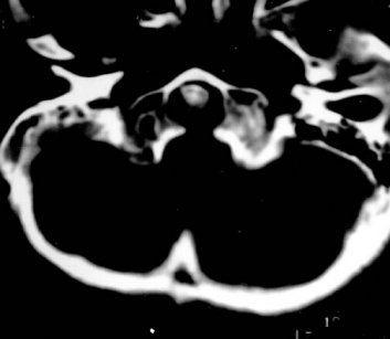 The hyperintense odontoid process is seen indenting the brain stem (the high MRI T1 contract of the odontoid process is due to increased