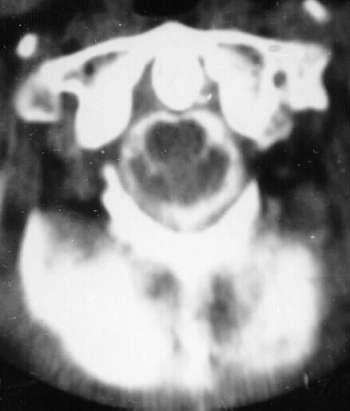 Figure 18. CT myelography showing basilar invagination associated with Arnold Chiari malformation.
