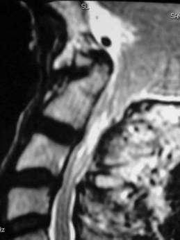 Notice the extradural space occupying lesion compressing and anteriorly displacing the upper cervical sinal cord. Figure 5. MRI T2,T1 images.