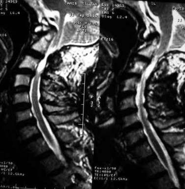anteriorly displacing the upper cervical sinal cord. Figure 6. MRI T2 images.
