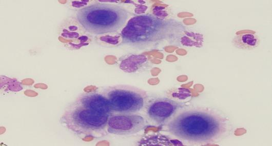 Cytology of mlignnt peritonel fluid y ppniculou stin Figure 3 ) nd ):