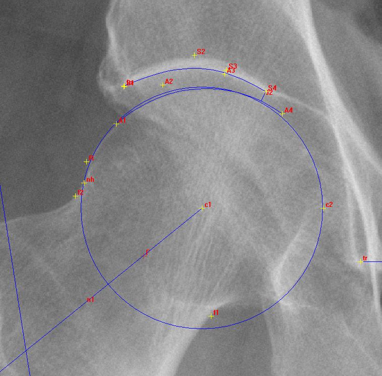 Radiographic Assessments All radiographs were assessed for: Individual features of OA -osteophytes (0-3) -joint space narrowing (JSN) (0-3) (grade>2) -subchondral sclerosis (0-1) - cysts (0-1) -