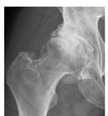Altered joint morphology Osteoarthritis Biomechanical effects of