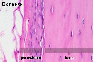 Osteophyte