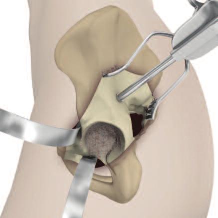 STEP 2 ACETABULAR PREPARATION The acetabulum is prepared by the release and removal of soft tissue using the surgeon s preferred technique to gain adequate exposure for reaming.