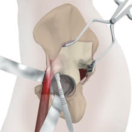 NOTE Careful identification and removal of osteophytes can help reduce the possibility of bone-to-bone or component-to-bone impingement. With the acetabulum exposed, bony defects can be identified.