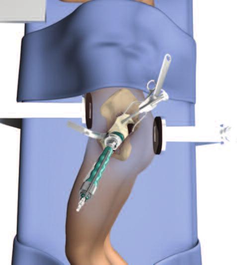 be inserted is attached to the power reamer. The Rim Cutter is designed to cut a groove in the periphery of the acetabulum of the appropriate diameter for the flange.