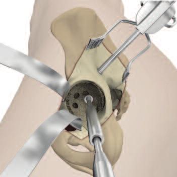 STEP 5 CEMENT FIXATION BONE PREPARATION After completion of reaming, multiple fixation holes should be made in the subchondral plate using the acetabular step drill.