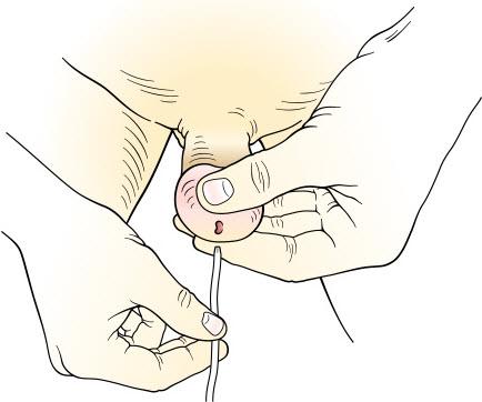 6. Insert the catheter slowly and smoothly into the opening of the urethra and up into the bladder until the urine starts to flow.