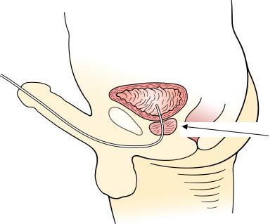 When the urine starts to flow, gently push the catheter in a little bit, to make sure that the drainage holes are well into the bladder. 8.