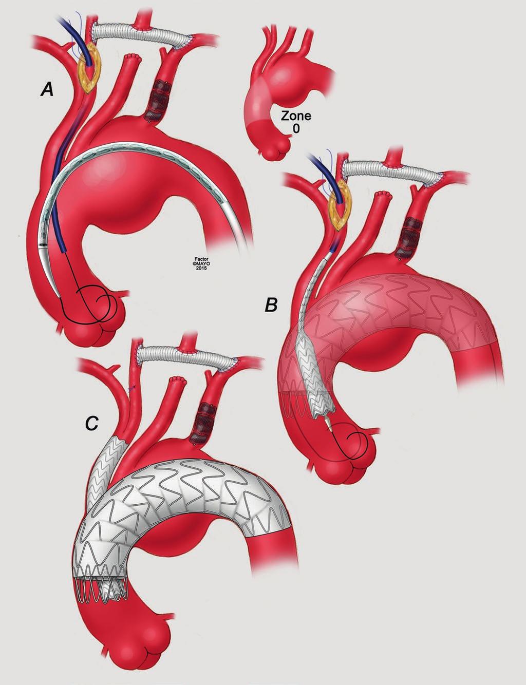 Fig. 35.5 (a) Surgical crossover bypass to the LCCA and to the LSA. (b) Deployment of the IA stent is completed.