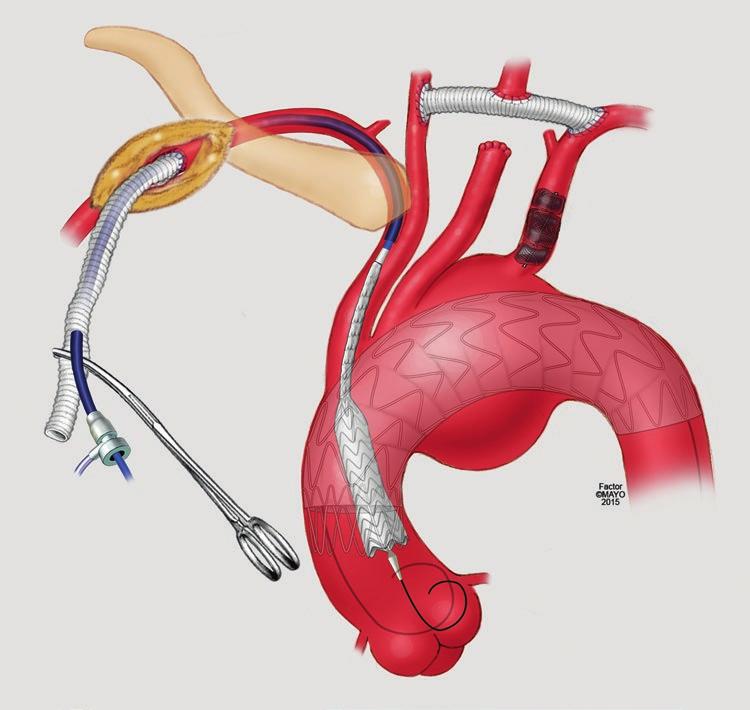35 Parallel Stent Graft Techniques to Facilitate Endovascular Repair in the Aortic Arch 553 Fig. 35.