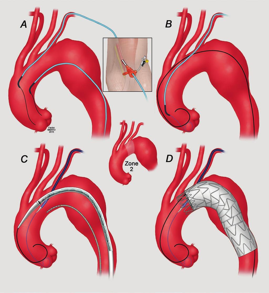 35 Parallel Stent Graft Techniques to Facilitate Endovascular Repair in the Aortic Arch 545 Fig. 35.1 Technique of parallel stent graft for Zone 2 thoracic endovascular aortic repair.