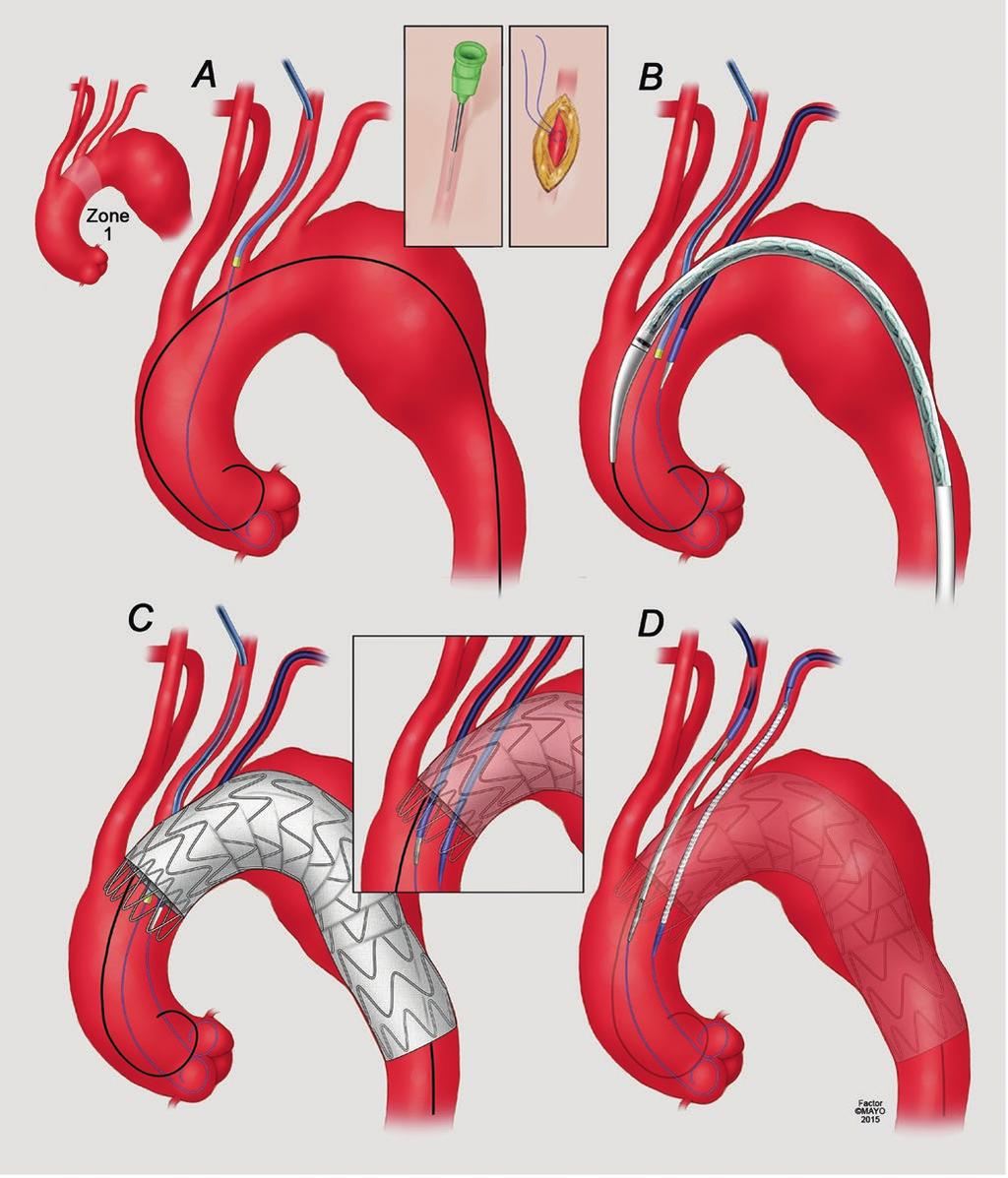 35 Parallel Stent Graft Techniques to Facilitate Endovascular Repair in the Aortic Arch 549 Fig. 35.3 (a) Access via left carotid artery (retrograde) using percutaneous puncture or small incision.