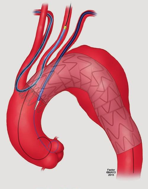 35 Parallel Stent Graft Techniques to Facilitate Endovascular Repair in the Aortic Arch 551 in Fig. 35.