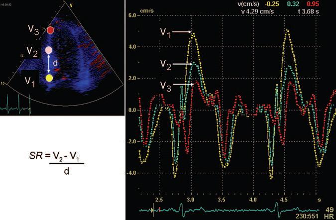 Differentiation Between Pathologic and Physiologic Left Ventricular Hypertrophy by Tissue Doppler Assessment of Long- Axis Function in Patients with Hypertrophic Cardiomyopathy or Systemic
