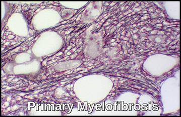 Myelofibrosis primary or secondary bone marrow replaced by fibrous(scar) tissue 1-2 cases