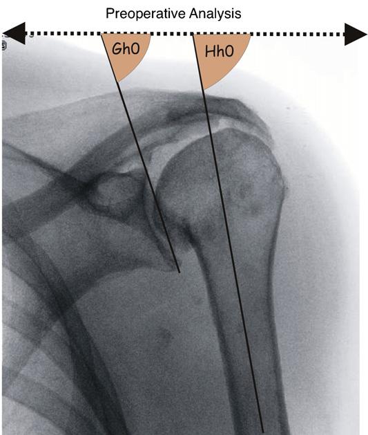 S132 V. Falaise et al. Introduction Glenohumeral arthropathies with rotator cuff deficiencies are very debilitating, painful and difficult to treat when medical treatment is unsuccessful.