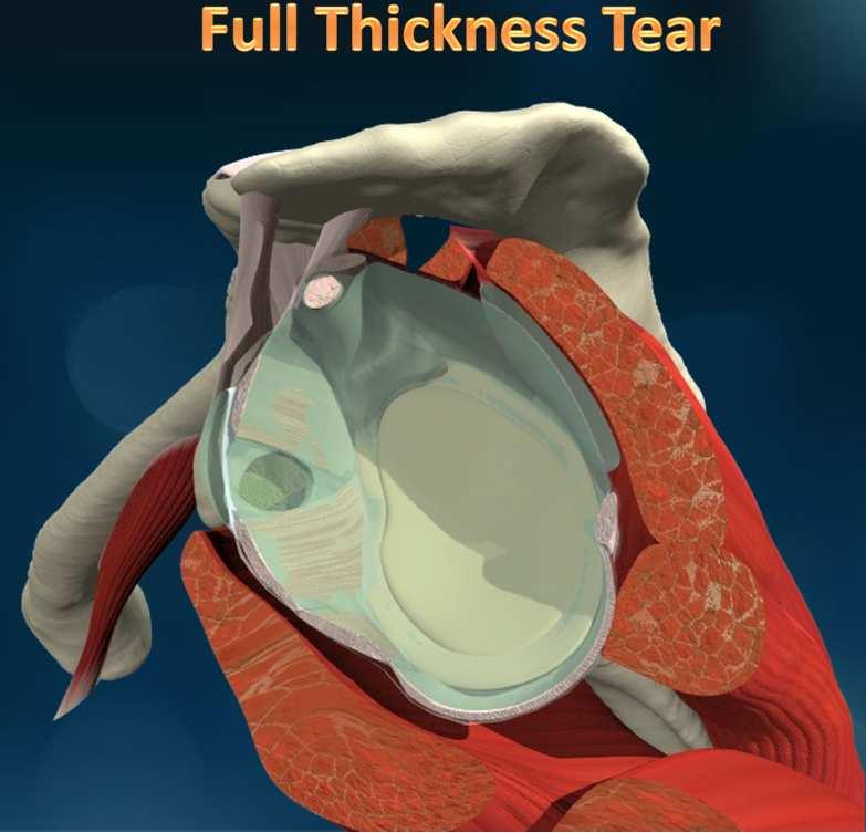 partial thickness tear