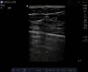 Lung Point/HFO Pneumothorax Critical Care Ultrasound