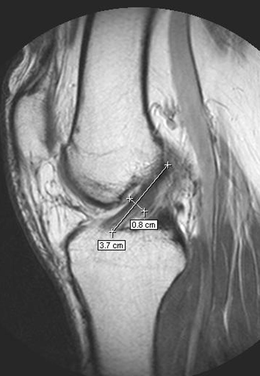 2 Radiological Study of Anterior Cruciate Ligament of the Knee Joint in Adult Human and its Surgical Implication table that slides into a large tunnel like scanner.