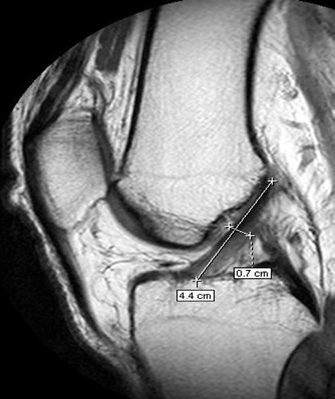 Image of MRI sagittal plane showing the way of computerized anterior cruciate ligament measured 3.7 cm length and 0.8 cm thick.