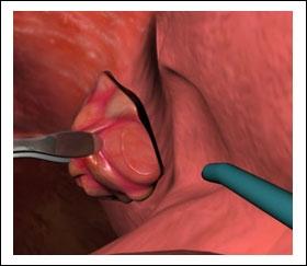 21) If indicated, your surgeon will perform the tonsillectomy to remove the tonsils. (Fig.