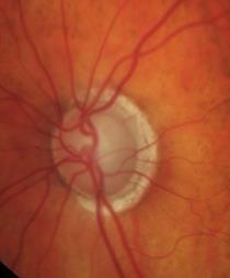 treatment than glaucoma Wants to see change or other conclusive proof of need for treatment.