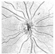 the OCT fundus image, illustrates precisely where RNFL thickness deviates from the normal range.