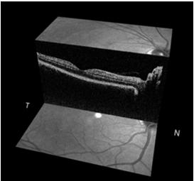According to limited evidence available sensitivity and specificity of imaging instruments for detection of glaucoma are comparable to that of expert 3.