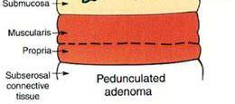 The distribution of adenomas within the colorectum is similar to that of colorectal carcinoma.