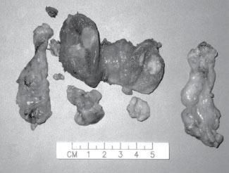 phaeochromocytoma, and multiple mucosal neuromas, and this syndrome was termed MEN type 2B in 1975 by Chong et al.