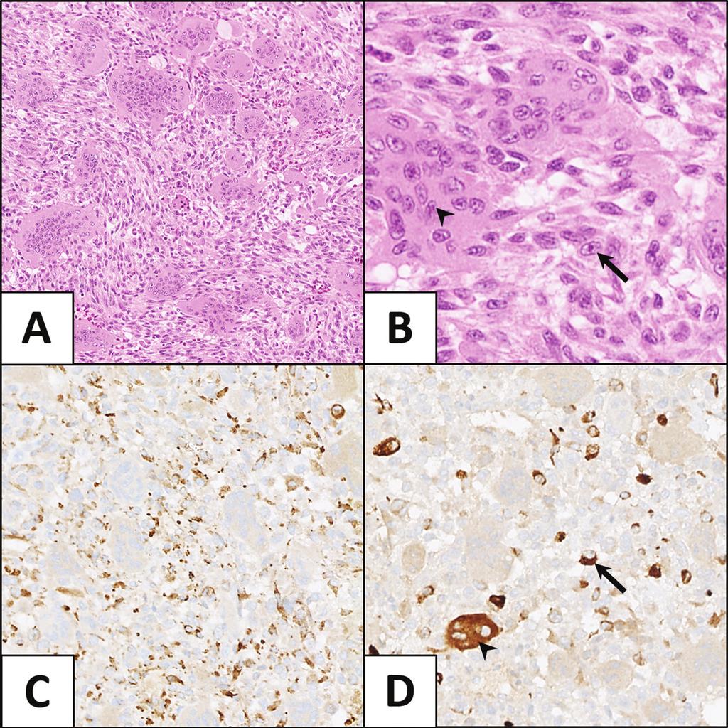 CASE REPORT Fig. 1. Giant cell tumor of bone.