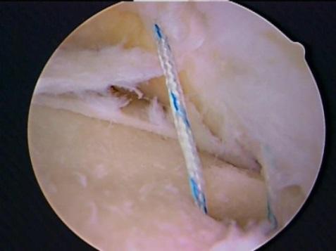 Remplissage - Technique Arthroscopic, includes Bankart repair Suture anchors placed within defect