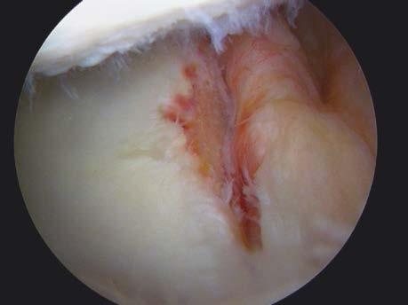 question isn t whether arthroscopic Bankart is as good in