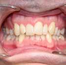 teeth Widley spaces