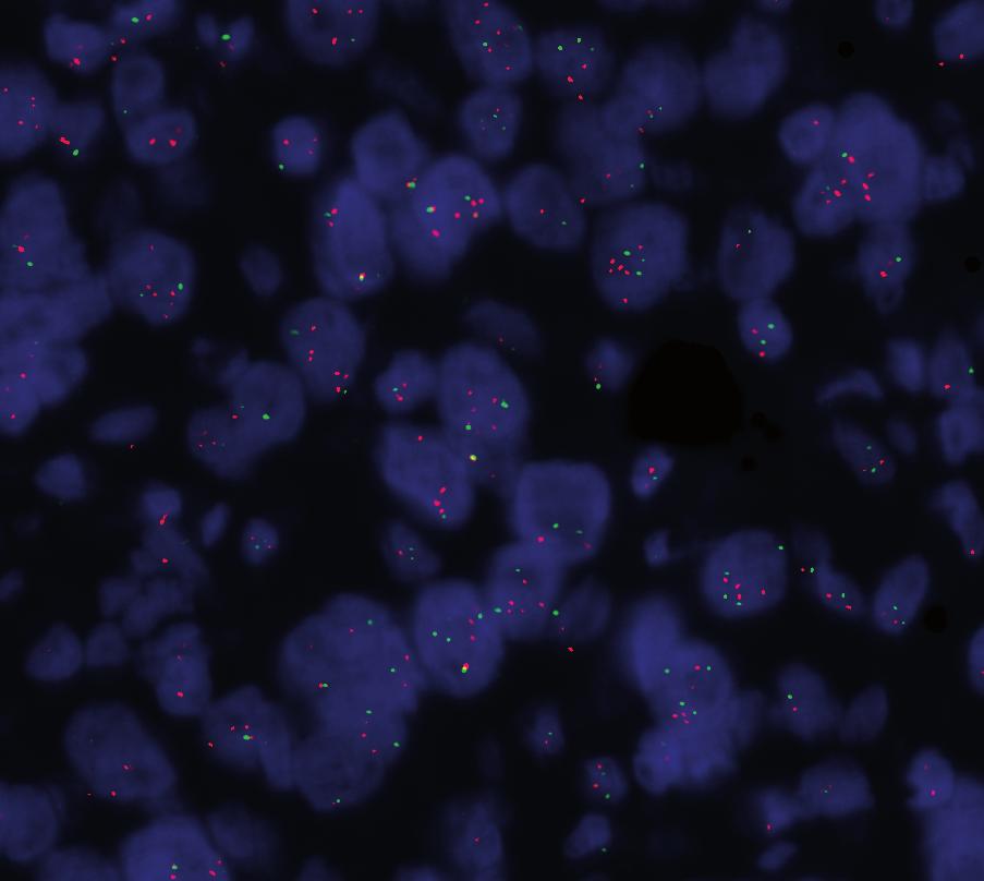 Breast carcinoma (FFPE) stained with HER2 IQFISH
