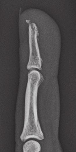 Chapter 1 Fractures and dislocations of the fingers Felix S. Chew, M.D.