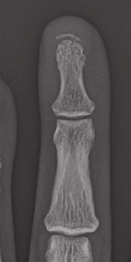 Case 1 1 Phalangeal tuft avulsion fracture 31-year-old woman injured in a ground-level fall.