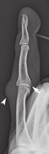 Chew and Maldjian Case 1 17 Volar plate fracture 58-year-old man who jammed his ring finger when he fell on the stairs. Lateral and PA radiographs of the left ring finger.