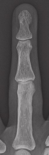 There is a very small, minimally displaced fracture of the middle phalanx at the volar margin at the PIP joint that corresponds to the attachment of the volar plate (arrow).
